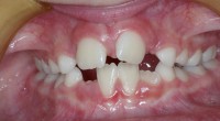 early treatment 1
