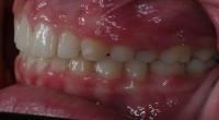 front bite 3